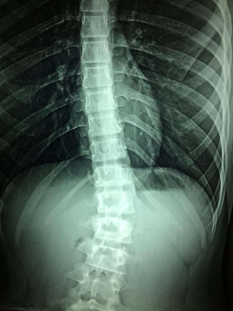 Spinal-Decompression