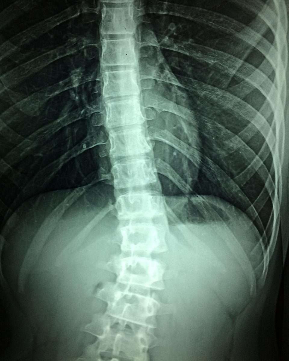 Spinal-Decompression