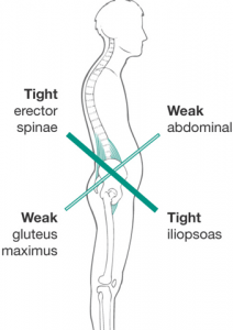Lower Crossed Syndrome